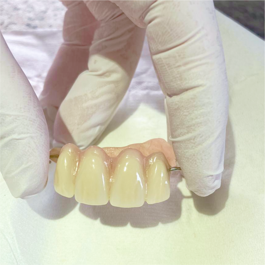 Partial-Denture Example