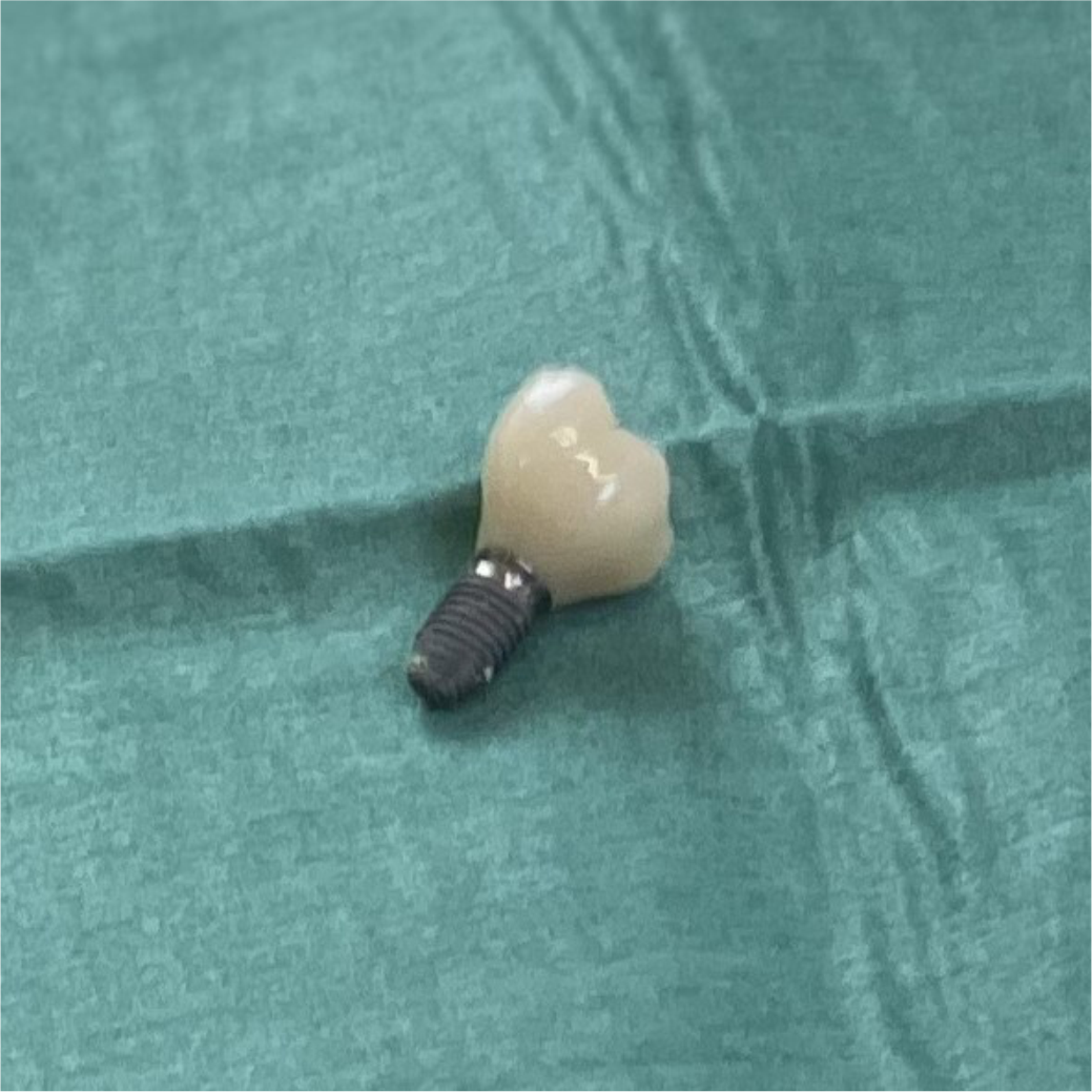 An Example Of A Dental Implant