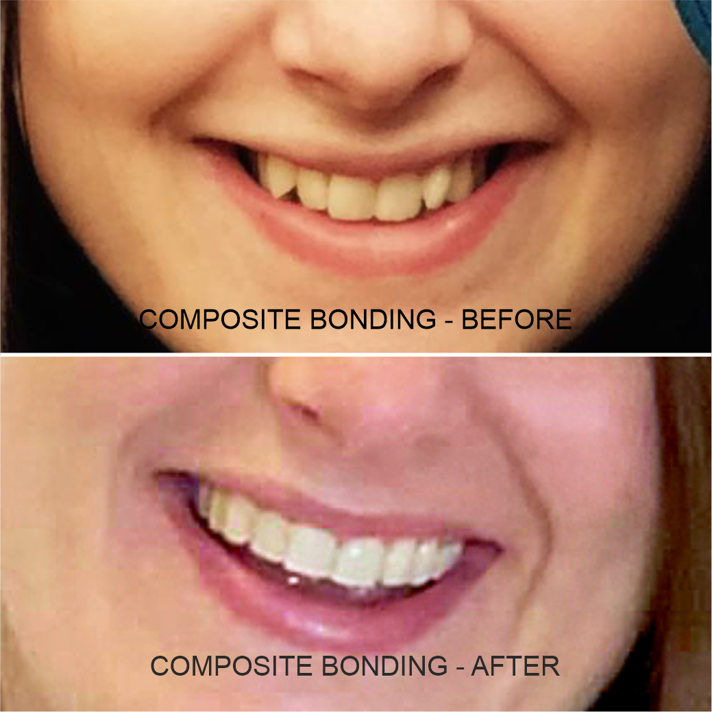 Before & After Shot Of Composite Bonding