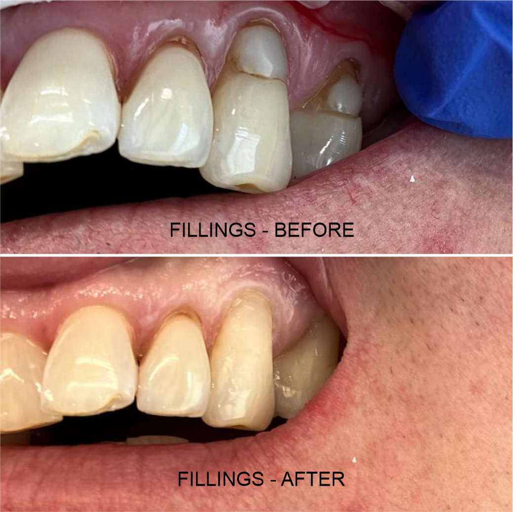 White Fillings - Before & After Shots